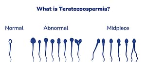 Fertility Articles 1 What is Teratozoospermia? A Detailed Guide to Understanding Causes and Symptoms